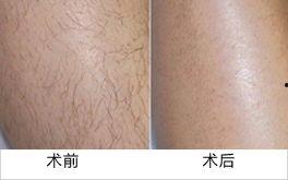 男士脱毛视频,轻松告别毛发烦恼
